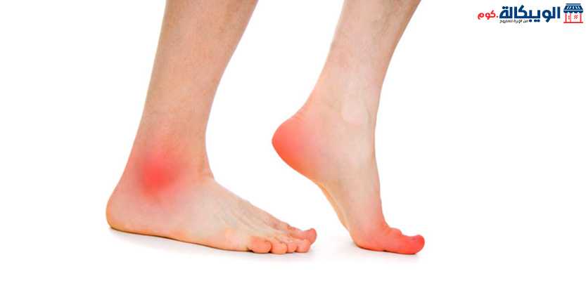 علاج تورم اصابع القدم بسبب الحذاء | علاج آثار الحذاء الجديد | الويبكالة.كوم