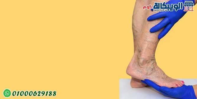 علاج دوالي الساقين علاج دوالي الساقين