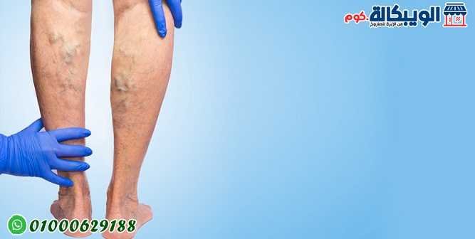 علاج دوالي الساقين علاج دوالي الساقين